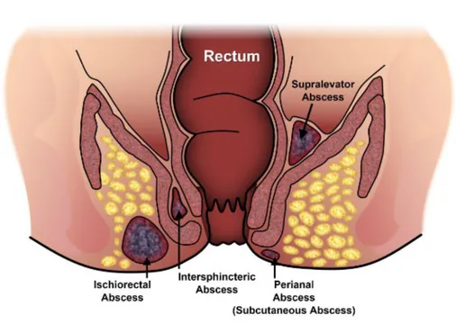 Perianal Abscess consultation at Niraaya Hospital